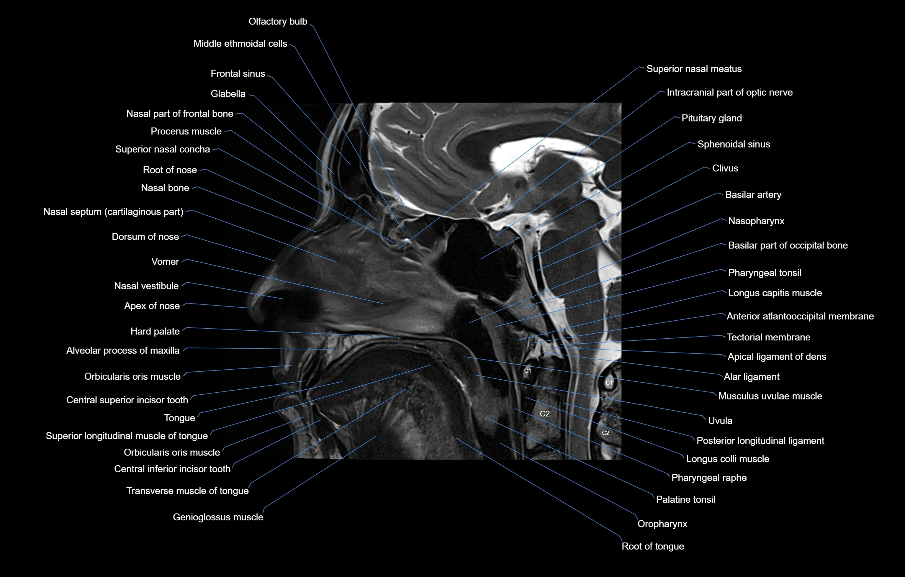 paranasal sinuses(PNS) MRI coronal  cross sectional anatomy 3T radiology  image-img-00001-00002.webp